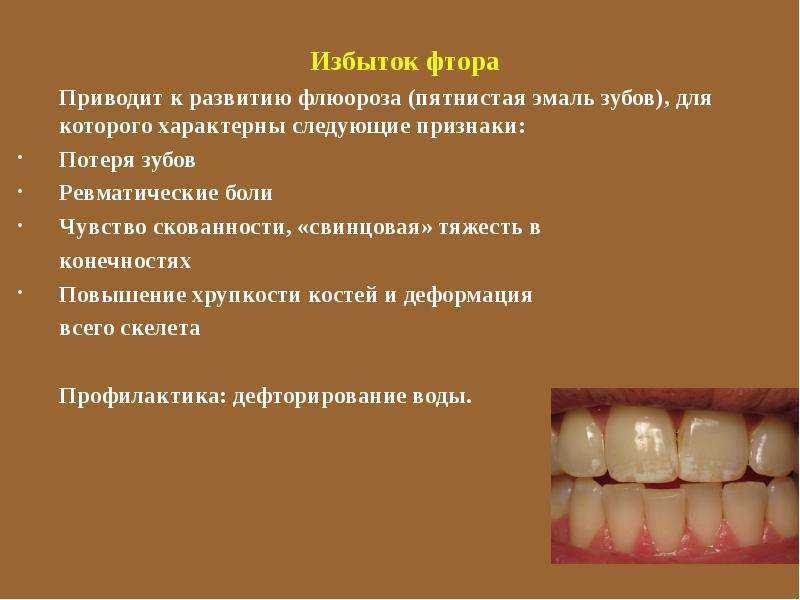 Польза и вред фтора в зубной пасте — мнение стоматологов.