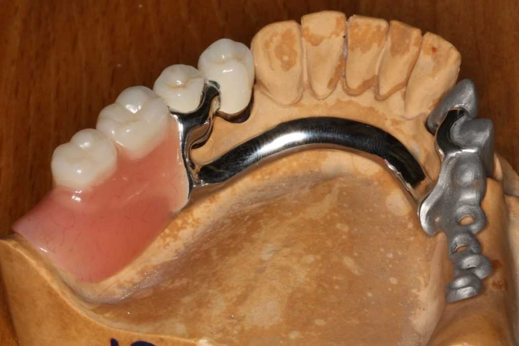 Съемные зубные протезы квадротти: конструкция, материал, виды, отличия от других протезов, этапы протезирования и уход