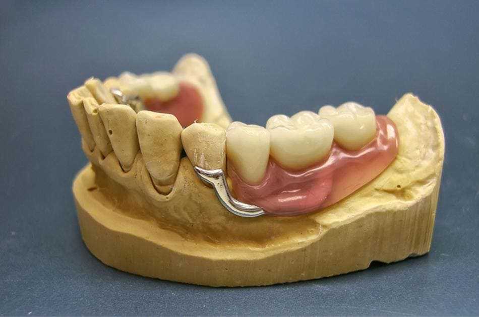 Стоит ли выбирать нейлоновый зубной протез? характеристики