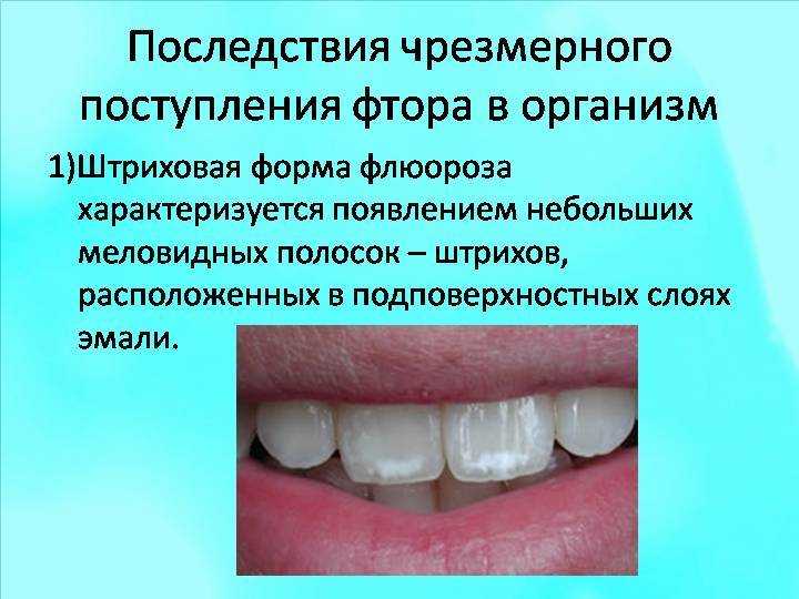 Поражение зубов из-за избытка фтора в воде: лечение флюороза — стоматология комфорта