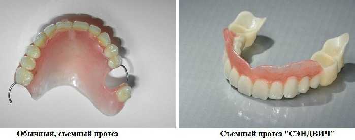Нейлоновые зубные протезы плюсы и минусы
