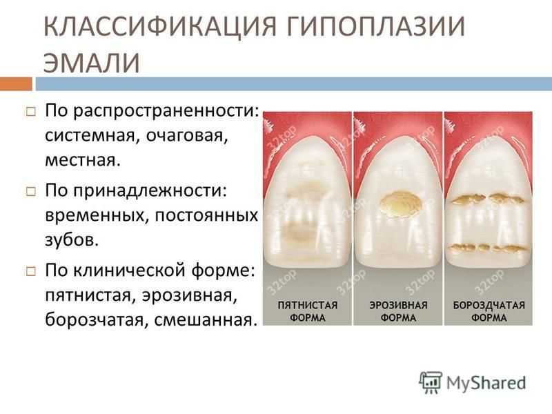 Фтор в зубной пасте: польза и вред