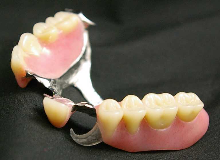 Какие зубные протезы лучше? какой зубной протез выбрать: виды, сравнение, цены