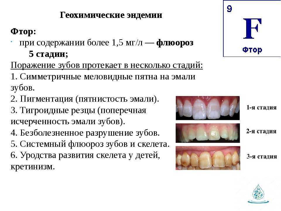 Почему зубы отличаются. Эндемический флюороз зубов. Флюороз временных зубов. Меловидно-крапчатая форма флюороза зубов.. Эндемические заболевания флюороз.