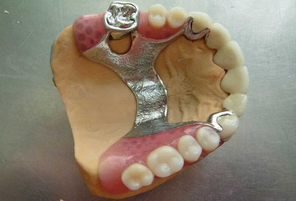 Какие зубные протезы лучше