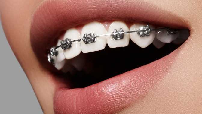 Установка металлических брекетов в стоматологической клинике telo's beauty