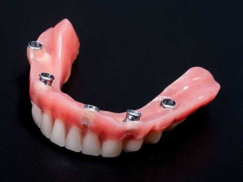 Какие зубные протезы лучше?