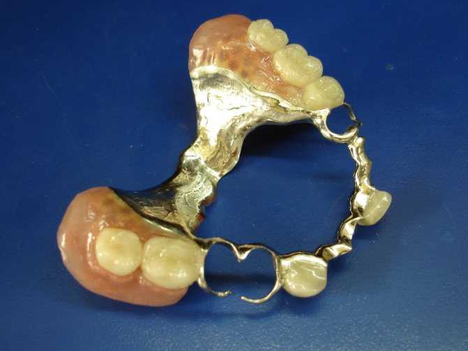 Бюгельные зубные протезы: виды, плюсы и минусы, цены на бюгельное протезирование в спб - анле-дент
