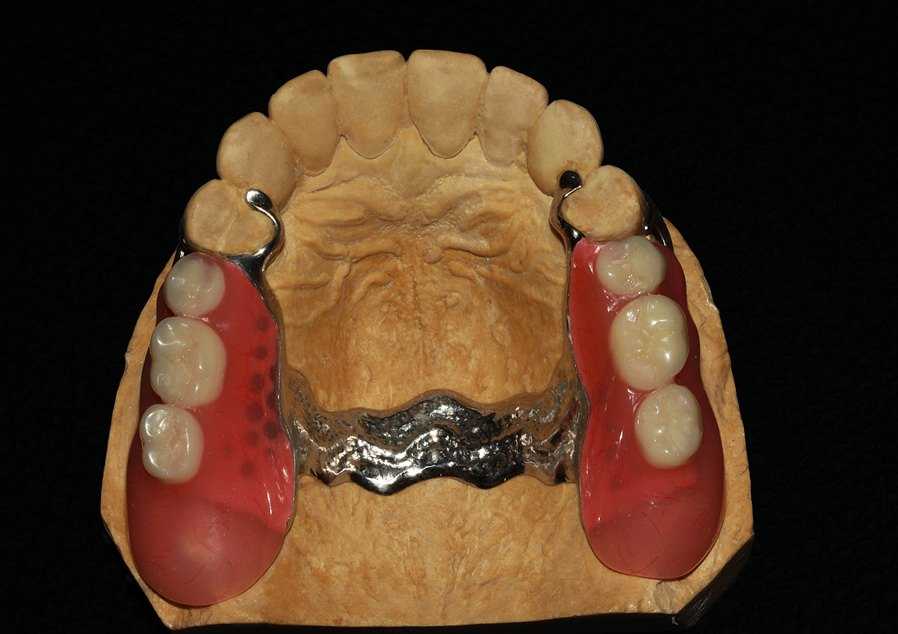 Съемные зубные протезы: как выбрать лучший вариант | стоматология 24